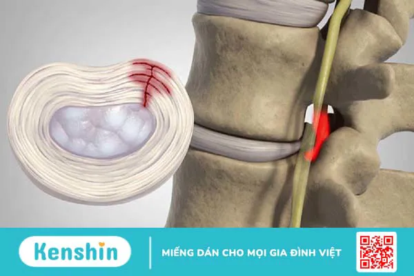 Thoát vị đĩa đệm nội xốp là bệnh gì? Cách phòng tránh và điều trị 1