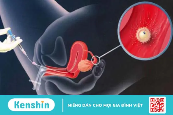 Thụ tinh nhân tạo cho mẹ đơn thân có hợp pháp không?