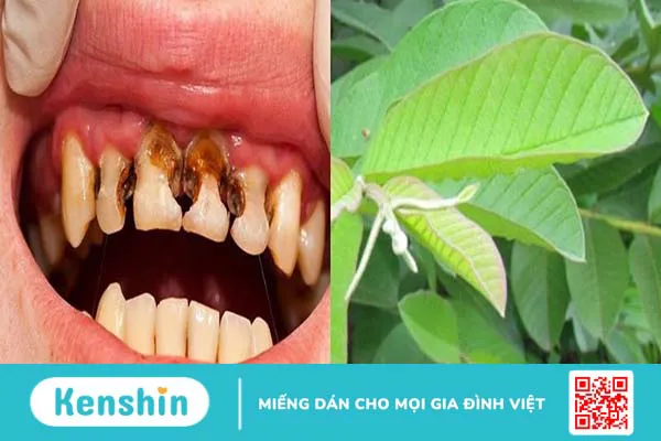 Thực hư kinh nghiệm sâu răng uống cây gì?