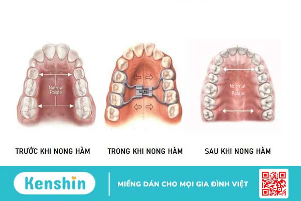 Thực hư về tác hại của nong hàm trong chỉnh nha