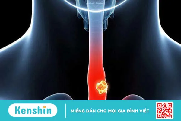 Thực quản: Chức năng và bệnh lý thường gặp 4