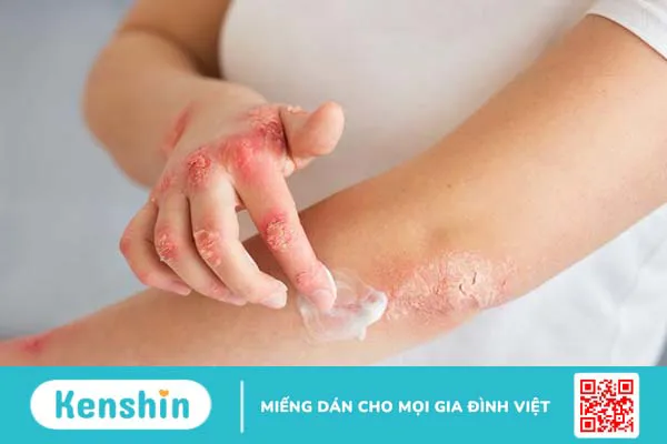 Thuốc 7 màu có trị lác đồng tiền được không 2