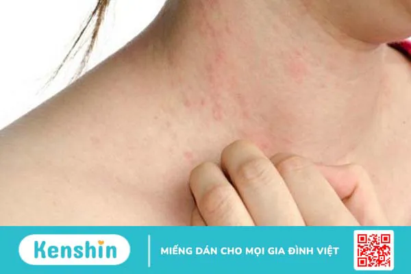 Thuốc mỡ là gì? Thuốc mỡ kháng sinh có tác dụng gì?