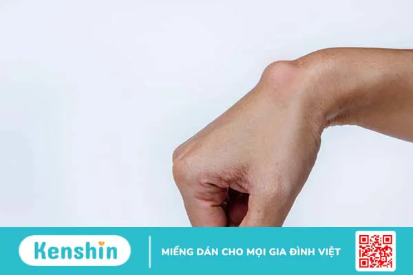 Thuốc tiêu u mỡ và các phương pháp điều trị u mỡ