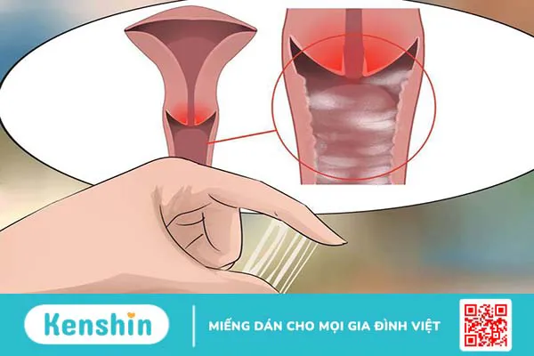 Cơ chế của thuốc tránh thai khẩn cấp là tăng tiết chất nhầy cổ tử cung do đó ngăn chặn quá trình thụ tinh