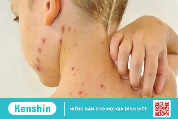 Thủy đậu có ngứa không? Những điều cần lưu ý khi bị thuỷ đậu