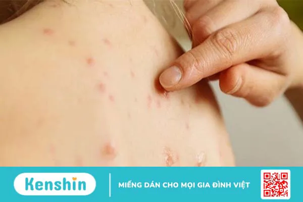 Thủy đậu có ngứa không? Những điều cần lưu ý khi bị thuỷ đậu 4