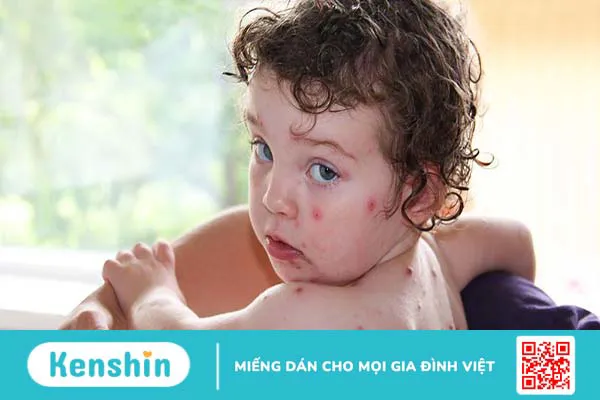 Thủy đậu đóng vảy còn lây không? Cách chăm sóc người bệnh thủy đậu