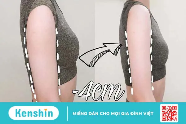 Tiêm botox bắp tay - Phương pháp thẩm mỹ không xâm lấn 2