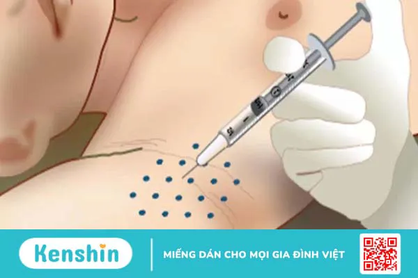 Tiêm botox trị hôi nách có hiệu quả không? Ưu và nhược điểm khi tiêm botox