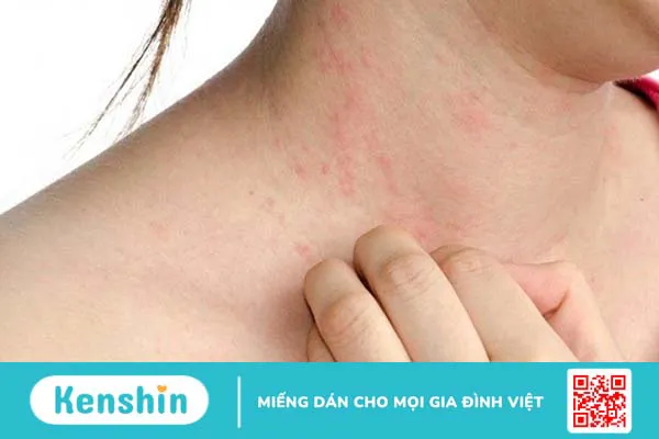 Tiêm tan mỡ là gì? Có an toàn không? 4