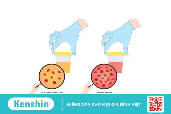 Tiểu máu vi thể: Nguyên nhân và cách điều trị