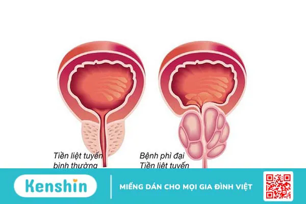 Tiểu máu vi thể: Nguyên nhân và cách điều trị 3