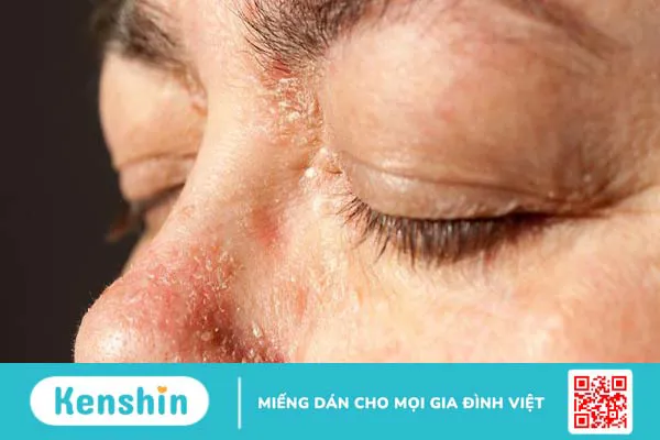 Tìm hiểu bệnh vảy nến da mặt và cách chữa trị hiệu quả