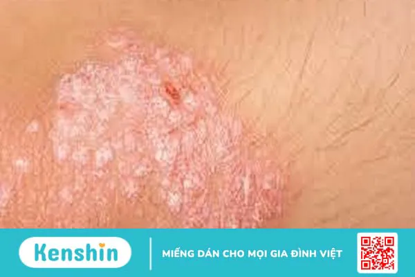 Tìm hiểu bệnh vảy nến ở mũi và cách điều trị