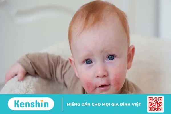 Tìm hiểu các dạng viêm da dị ứng ở trẻ nhỏ và cách phòng ngừa