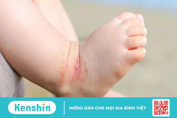 Tìm hiểu các dạng viêm da dị ứng ở trẻ nhỏ và cách phòng ngừa