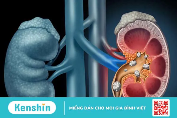 Tìm hiểu các phương pháp tán sỏi thận phổ biến hiện nay