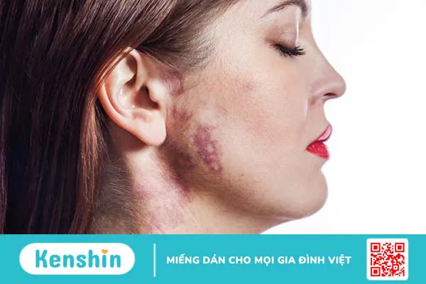 Tìm hiểu chi tiết về phẫu thuật u thần kinh trên da