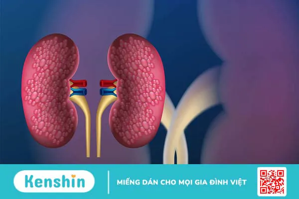 Bệnh thận mạn tính có thể dẫn đến tình trạng đái tháo nhạt có nguồn gốc do thận