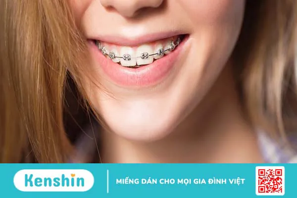 Tìm hiểu về các loại niềng răng phổ biến hiện nay