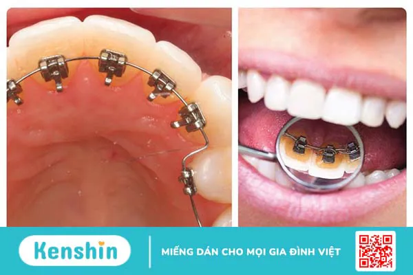 Tìm hiểu về các loại niềng răng phổ biến hiện nay