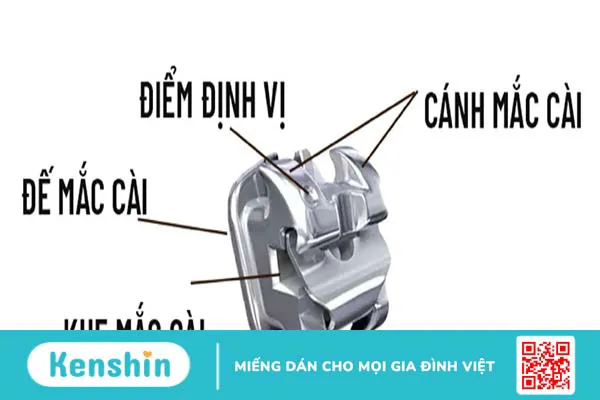 Tìm hiểu về các loại niềng răng phổ biến hiện nay