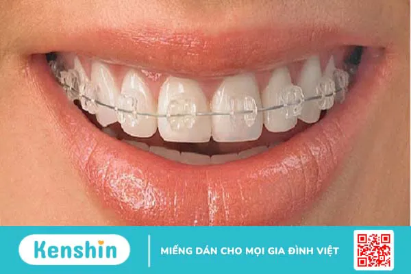 Tìm hiểu về các loại niềng răng phổ biến hiện nay