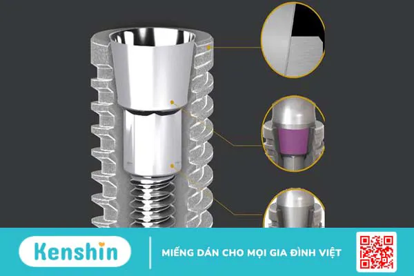 Tìm hiểu về đặc điểm và lợi ích khi cấy Implant Neodent 2