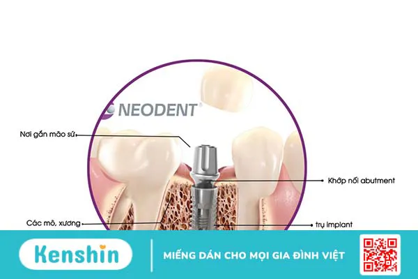 Tìm hiểu về đặc điểm và lợi ích khi cấy Implant Neodent 3