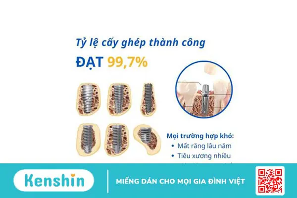 Tìm hiểu về đặc điểm và lợi ích khi cấy Implant Neodent 4