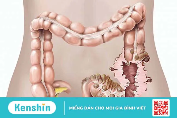 Tìm hiểu về đại tràng và những bệnh thường gặp ở đại tràng 4