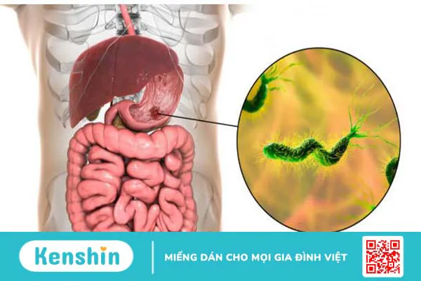 Tìm hiểu về một số triệu chứng ung thư dạ dày giai đoạn đầu