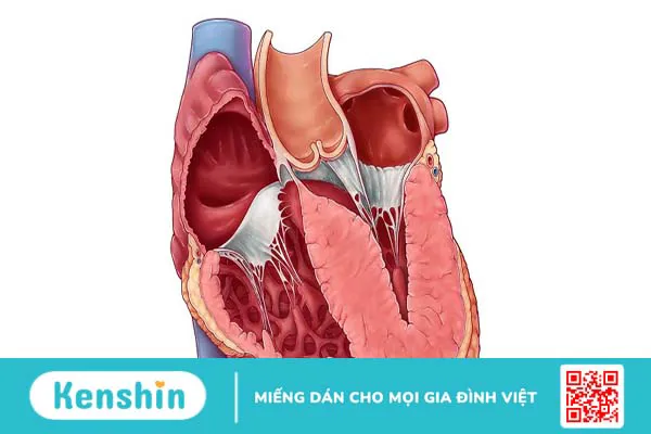 Tìm hiểu về phẫu thuật cắt bỏ vách ngăn cơ tim phì đại 1