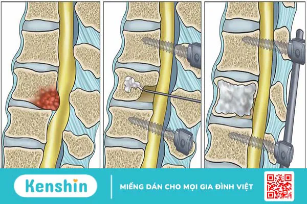 Tìm hiểu về phương pháp bơm xi măng cột sống điều trị xẹp đốt sống 2