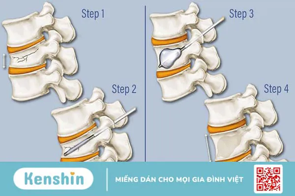 Tìm hiểu về phương pháp bơm xi măng cột sống điều trị xẹp đốt sống 1