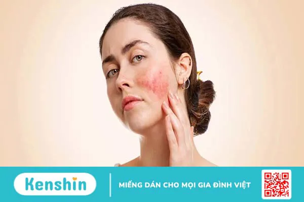 Tìm hiểu về phương pháp điều trị lupus ban đỏ bằng tế bào gốc