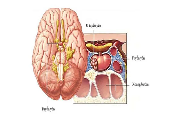 Tìm hiểu về phương pháp phẫu thuật u tuyến yên bằng đường mở nắp sọ