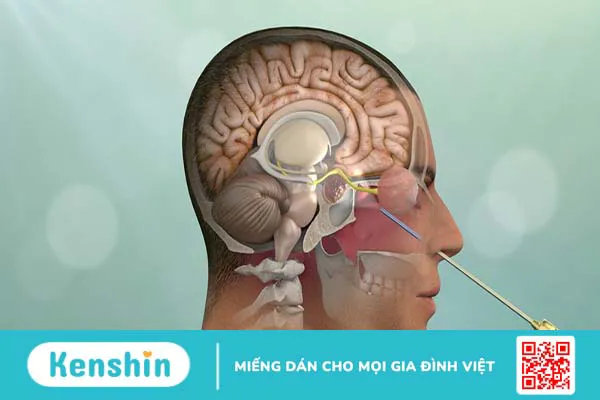 Tìm hiểu về phương pháp phẫu thuật u tuyến yên bằng đường mở nắp sọ