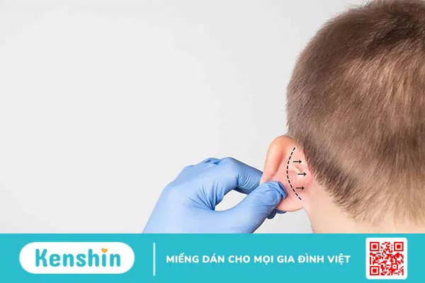 Tìm hiểu về quy trình phẫu thuật tai vểnh  1