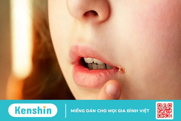 Tìm hiểu về tình trạng chốc mép ở trẻ em