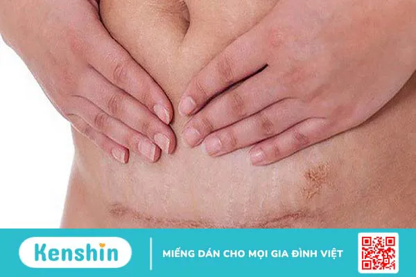 Thai bám ở sẹo mổ lấy thai nếu không phát hiện sớm có thể gây nguy hiểm đến tính mạng