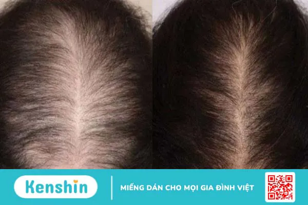 Tóc ít bẩm sinh thì phải làm sao để cải thiện?