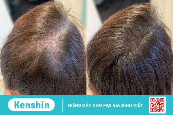 Tóc ít bẩm sinh thì phải làm sao để cải thiện?