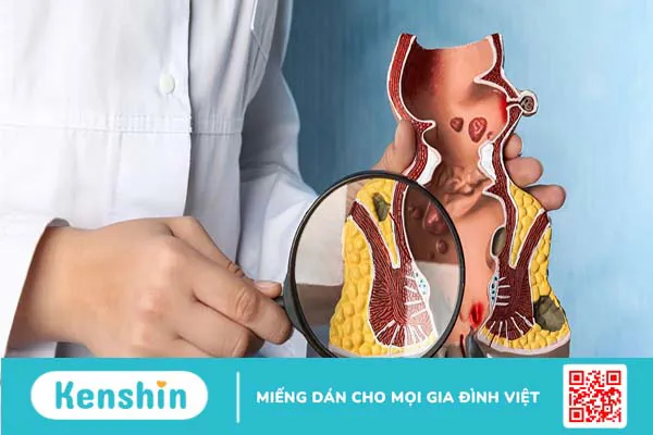 Tổng hợp những cách chữa bệnh trĩ được sử dụng phổ biến