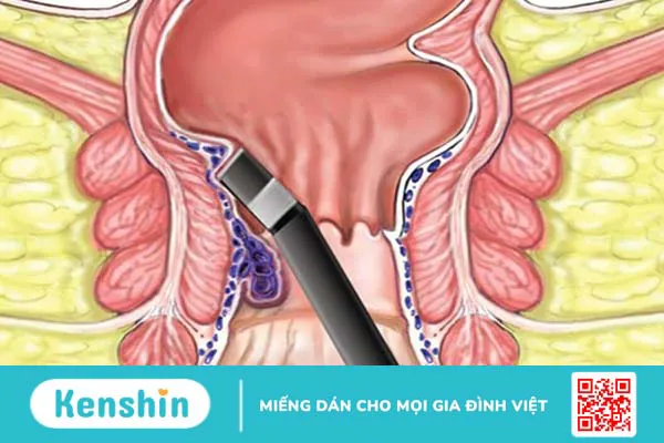 Tổng hợp những cách chữa bệnh trĩ được sử dụng phổ biến