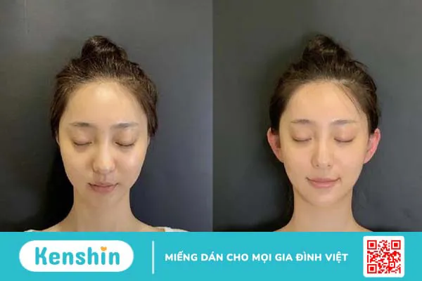 Trào lưu phẫu thuật tai yêu tinh tiềm ẩn nhiều rủi ro