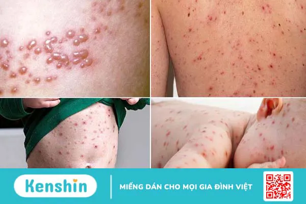 Trẻ bị phỏng dạ: Nguyên nhân, triệu chứng và cách điều trị hiệu quả