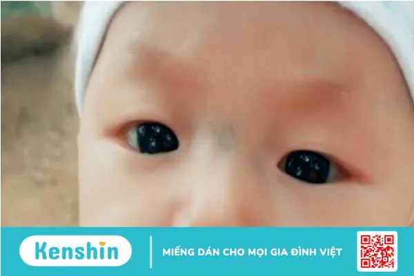 Trẻ sơ sinh có gân xanh ở sống mũi có nguy hiểm không?