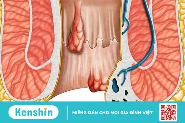 Trĩ hỗn hợp: Nguyên nhân, triệu chứng và cách điều trị